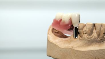 Häufig können Knochenaufbau und Implantation zusammen erfolgen.