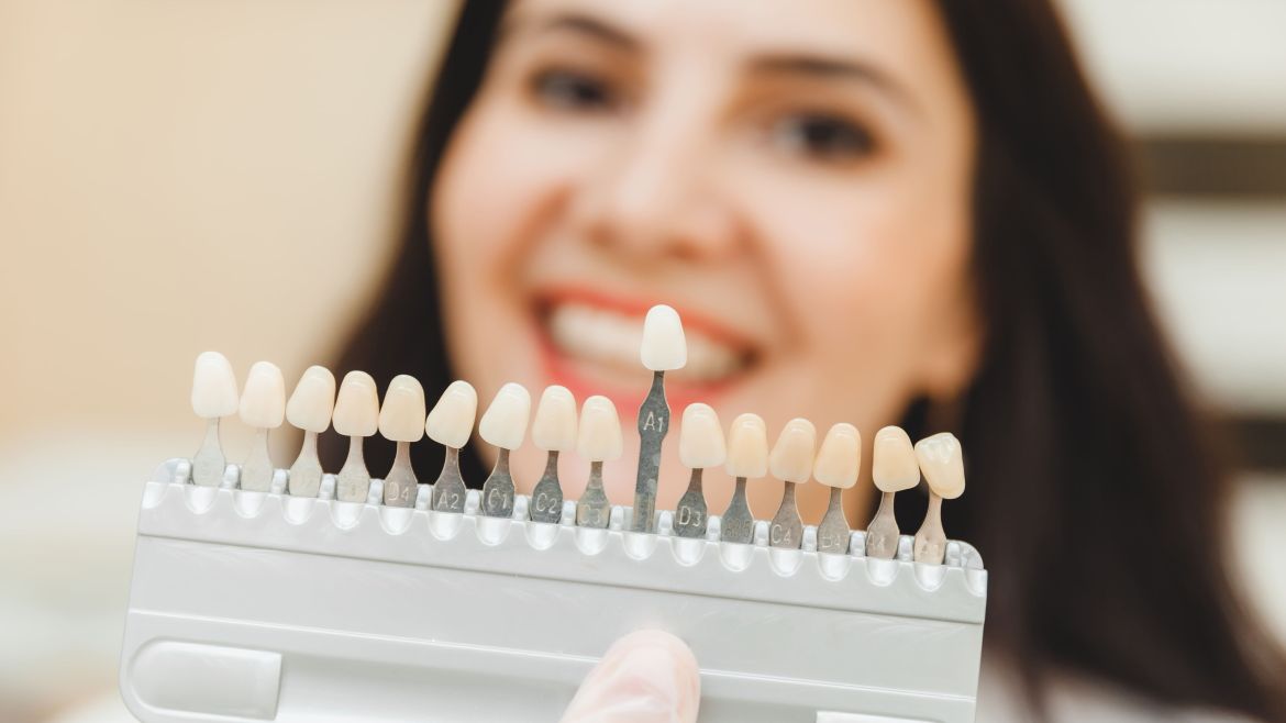 Veneers werden der gewünschten Zahnfarbe angepasst
