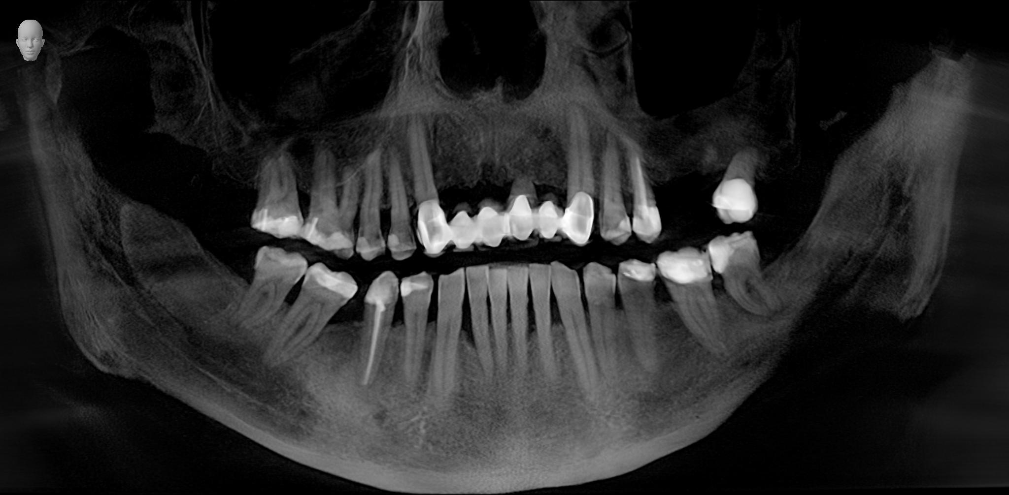 🦷 2 Implantate mit Sinuslift und CEREC Zahnersatz - HKP aus Polen