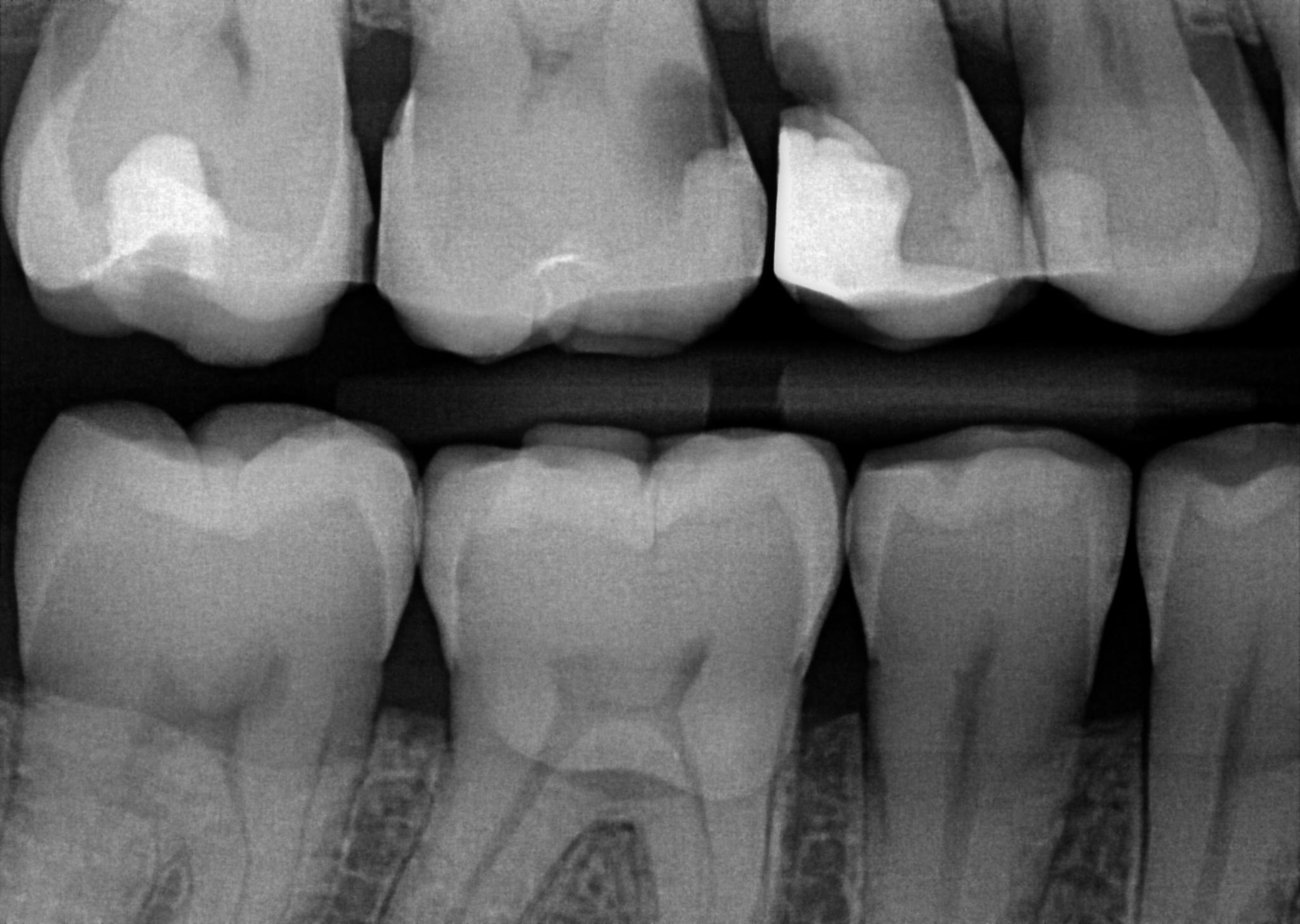 🦷 3 Teilkronen und 1 Krone mit Wurzelkanalbehandlung